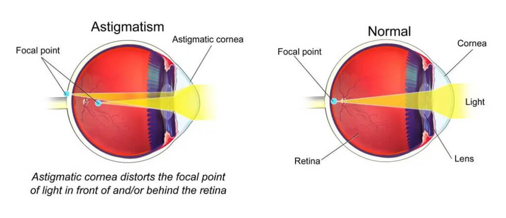 What is astigmatism?